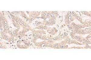 Immunohistochemistry of paraffin-embedded Human liver cancer tissue using ENO4 Polyclonal Antibody at dilution of 1:30(x200) (ENO4 Antikörper)