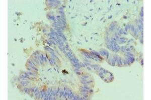Immunohistochemistry of paraffin-embedded human colon cancer using ABIN7156372 at dilution of 1:100 (IGFBP4 Antikörper  (AA 22-258))