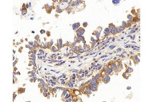 Immunohistochemistry analysis of paraffin-embedded human lung cancer using PERK Polyclonal Antibody at dilution of 1:400. (PERK Antikörper)