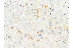 ABIN6256986 and ABIN6275171 at 1/100 staining human astrocytoma by IHC-P.