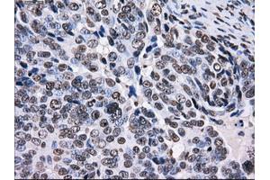 Immunohistochemical staining of paraffin-embedded Adenocarcinoma of colon tissue using anti-RPA2 mouse monoclonal antibody. (RPA2 Antikörper)