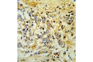 Immunohistochemistry analysis in formalin fixed and paraffin embedded breast carcinoma reacted with LMBR1L Antibody (C-term) followed which was peroxidase conjugated to the secondary antibody and followed by DAB staining. (LMBR1L Antikörper  (C-Term))