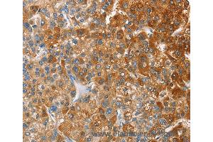 Immunohistochemistry of Human thyroid cancer using CD200R1 Polyclonal Antibody at dilution of 1:60 (HCRTR2 Antikörper)