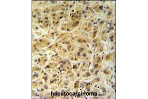 GNS Antibody (Center N189) IHC analysis in formalin fixed and paraffin embedded human hepatocarcinoma followed by peroxidase conjugation of the secondary antibody and DAB staining.