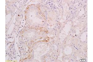 Formalin-fixed and paraffin embedded human renal carcinoma labeled with Anti-BAFFR/CD268 Polyclonal Antibody, Unconjugated (ABIN740760) at 1:200 followed by conjugation to the secondary antibody (TNFRSF13C Antikörper  (AA 121-184))