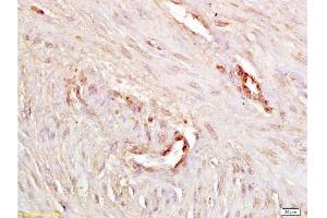 Formalin-fixed and paraffin embedded human endometrium carcinoma labeled with Anti P-cadherin Polyclonal Antibody, Unconjugated  at 1:200 followed by conjugation to the secondary antibody and DAB staining. (P-Cadherin Antikörper  (AA 625-725))