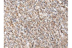 The image on the left is immunohistochemistry of paraffin-embedded Human gastric cancer tissue using ABIN7130604(PGRMC2 Antibody) at dilution 1/20, on the right is treated with fusion protein. (PGRMC2 Antikörper)