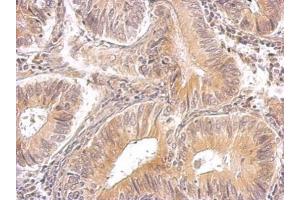 IHC-P Image RRM1 antibody detects RRM1 protein on human gastric cancer by immunohistochemical analysis. (RRM1 Antikörper  (Center))