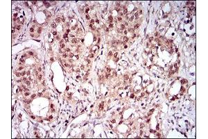 Immunohistochemical analysis of paraffin-embedded cervical cancer tissues using NBN mouse mAb with DAB staining. (Nibrin Antikörper  (AA 467-615))