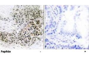 Immunohistochemistry analysis of paraffin-embedded human lung carcinoma tissue, using TRPS1 polyclonal antibody . (TRPS1 Antikörper  (AA 121-170))