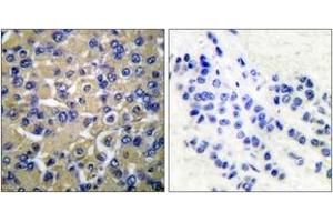 Immunohistochemistry analysis of paraffin-embedded human breast carcinoma tissue, using WNK1 (Ab-58) Antibody.