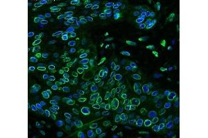 IF analysis of Emerin using anti-Emerin antibody (ABIN4886569) Emerin was detected in paraffin-embedded section of human oesophagus squama cancer tissues. (Emerin Antikörper  (N-Term))