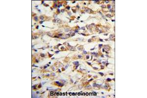 Formalin-fixed and paraffin-embedded human breast carcinoma with KRT14 Antibody , which was peroxidase-conjugated to the secondary antibody, followed by DAB staining. (KRT14 Antikörper  (AA 276-303))