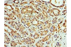 Immunohistochemistry of paraffin-embedded human breast cancer using ABIN7148496 at dilution of 1:100 (COPS4 Antikörper  (AA 1-310))