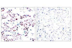 Immunohistochemical analysis of paraffin-embedded human breast carcinoma tissue using c-Jun(Phospho-Thr91) Antibody(left) or the same antibody preincubated with blocking peptide(right). (C-JUN Antikörper  (pThr91))