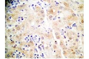 Human hepatocellular carcinoma tissue was stained by Rabbit Anti-FGF-21 (26-47) (H) (FGF21 Antikörper  (AA 26-47))