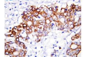 Anti-GCLC antibody, IHC(P) IHC(P): Human Rectal Cancer Tissue (GCLC Antikörper  (N-Term))