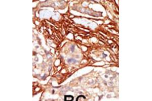 Formalin-fixed and paraffin-embedded human cancer tissue reacted with the primary antibody, which was peroxidase-conjugated to the secondary antibody, followed by AEC staining. (ARAF Antikörper  (AA 256-286))
