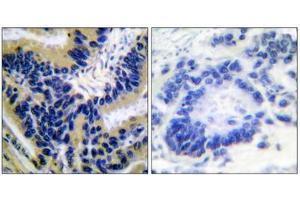 Immunohistochemical analysis of paraffin-embedded human lung carcinoma tissue, using Caspase 3 (cleaved-Asp175) antibody. (Caspase 3 Antikörper  (Cleaved-Asp175))