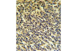 PLA2G6 Antibody (Center) (ABIN653895 and ABIN2843138) IHC analysis in formalin fixed and paraffin embedded testis carcinoma followed by peroxidase conjugation of the secondary antibody and DAB staining. (PLA2G6 Antikörper  (AA 551-580))