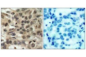 Immunohistochemical analysis of paraffin-embedded human breast carcinoma tissue, using cdc25C (Ab-216) antibody (E021145). (CDC25C Antikörper)