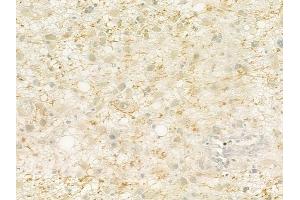 ABIN6260884 and ABIN6279308 at 1/100 staining human astrocytoma by IHC-P. (Claudin 23 Antikörper  (Internal Region))