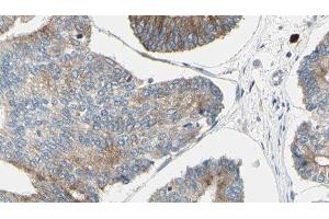 ABIN6276417 at 1/100 staining Human prostate tissue by IHC-P. (JUP Antikörper  (C-Term))