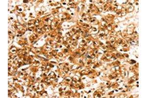 The image on the left is immunohistochemistry of paraffin-embedded Human prostate cancer tissue using ABIN7192494(SLC44A2 Antibody) at dilution 1/20, on the right is treated with synthetic peptide. (SLC44A2 Antikörper)