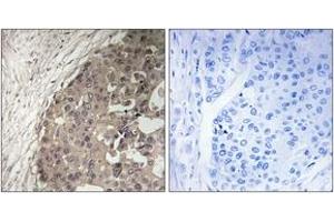 Immunohistochemistry analysis of paraffin-embedded human breast carcinoma tissue, using CSGALNACT1 Antibody. (CSGALNACT1 Antikörper  (AA 201-250))