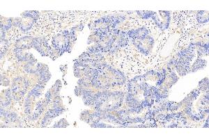 Detection of CAM in Human Colorectal cancer Tissue using Polyclonal Antibody to Calmodulin (CAM) (Calmodulin 1 Antikörper  (AA 2-149))