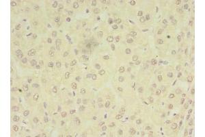 Immunohistochemistry of paraffin-embedded human liver cancer using ABIN7162969 at dilution of 1:100 (PEX11B Antikörper  (AA 9-228))