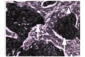 Immunohistochemical staining of paraffin embedded esophageal tumors using Act-MMP9 antibody . (MMP 9 Antikörper  (N-Term))
