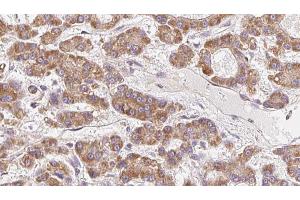 ABIN6272699 at 1/100 staining Human liver cancer tissue by IHC-P. (OR10H5 Antikörper  (C-Term))