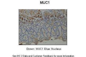 Sample Type :  Human stomach  Primary Antibody Dilution :  1:200  Secondary Antibody :  Anti-rabbit-HRP  Secondary Antibody Dilution :  1:1000  Color/Signal Descriptions :  Brown: MUC1 Blue: Nucleus  Gene Name :  MUC1  Submitted by :  Dr. (MUC1 Antikörper  (Middle Region))