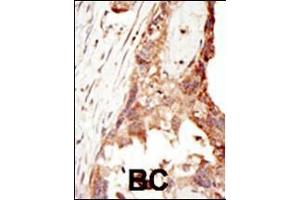 Formalin-fixed and paraffin-embedded human cancer tissue reacted with the primary antibody, which was peroxidase-conjugated to the secondary antibody, followed by DAB staining. (PRDM14 Antikörper  (N-Term))