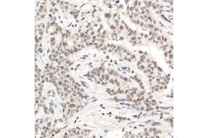 Immunohistochemistry of paraffin-embedded human breast cancer using [KO Validated] L3MBTL3 Rabbit pAb (ABIN6132145, ABIN6143061, ABIN6143062 and ABIN6223119) at dilution of 1:50 (40x lens).