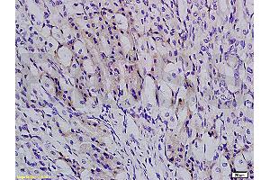 Formalin-fixed and paraffin embedded human colon carcinoma labeled with Anti-TBL1X Polyclonal Antibody, Unconjugated (ABIN705416) at 1:200 followed by conjugation to the secondary antibody and DAB staining
