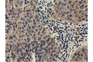 Immunohistochemical staining of paraffin-embedded Carcinoma of Human bladder tissue using anti-CBWD1 mouse monoclonal antibody. (CBWD1 Antikörper)