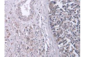 IHC-P analysis of Human Prostate Gland Cancer Tissue, with DAB staining. (Retinoic Acid Receptor beta Antikörper  (AA 205-451))
