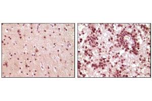 Immunohistochemical analysis of paraffin-embedded human brain tumor tissue, showing nuclear and cytoplasmic localization using ELK1 mouse mAb with DAB staining. (ELK1 Antikörper)