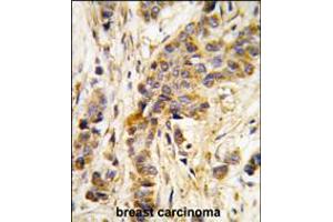 Formalin-fixed and paraffin-embedded human breast carcinoma tissue reacted with IARS2 antibody , which was peroxidase-conjugated to the secondary antibody, followed by DAB staining. (IARS2 Antikörper  (AA 600-628))