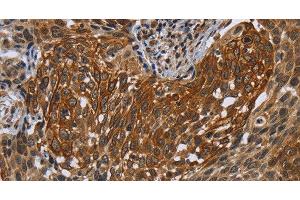 Immunohistochemistry of paraffin-embedded Human cervical cancer tissue using UHRF2 Polyclonal Antibody at dilution 1:40 (UHRF2 Antikörper)