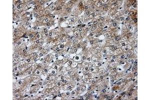 Immunohistochemical staining of paraffin-embedded Carcinoma of liver tissue using anti-SIL1 mouse monoclonal antibody. (SIL1 Antikörper)