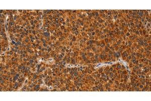 Immunohistochemistry of paraffin-embedded Human liver cancer tissue using IKZF3 Polyclonal Antibody at dilution 1:60 (IKZF3 Antikörper)