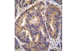 Immunohistochemistry analysis in formalin fixed and paraffin embedded human prostate carcinoma reacted with GTF2H2C Antibody (C-term) followed by peroxidase conjugation of the secondary antibody and DAB staining.