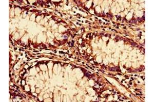 Immunohistochemistry of paraffin-embedded human colon cancer using ABIN7170624 at dilution of 1:100 (Pre-mRNA Branch Site Protein p14 (SF3B14) (AA 1-125) Antikörper)