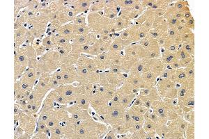 ABIN7096894 and ABIN7100960 at 1/100 staining human liver cancer by IHC-P. (PIGT Antikörper)
