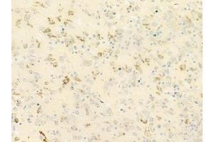 ABIN6264416 and ABIN6279652 at 1/100 staining human melanoma by IHC-P. (PREX1 Antikörper  (Internal Region))