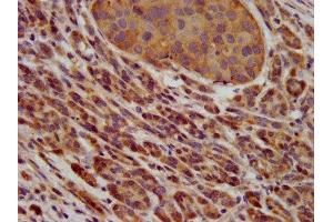IHC image of ABIN7163609 diluted at 1:600 and staining in paraffin-embedded human pancreatic cancer performed on a Leica BondTM system. (PAFAH1B3 Antikörper  (AA 103-187))