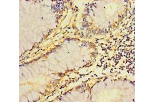 Immunohistochemistry of paraffin-embedded human colon cancer using ABIN7162535 at dilution of 1:100 (ZDHHC15 Antikörper  (AA 239-337))